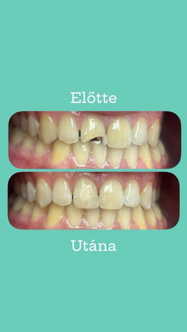 Előtte - Utána